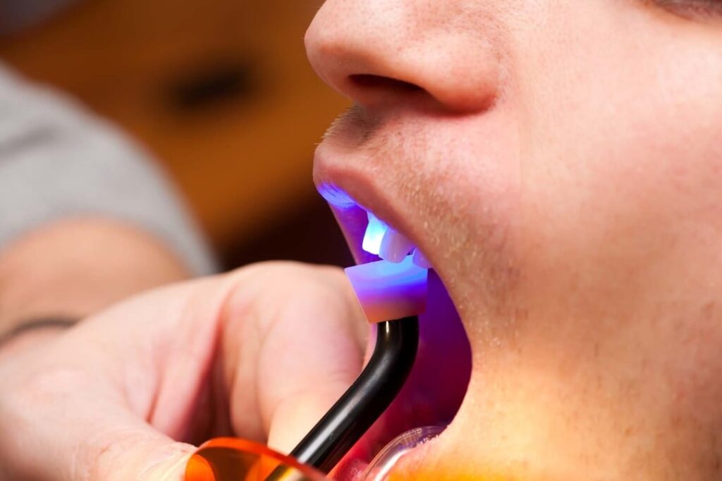 Dental Bonding - Bright Choice Dental