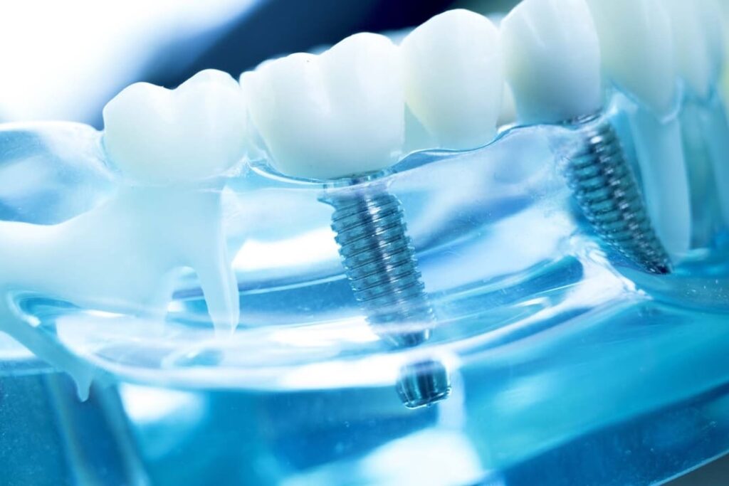 Implants - Bright Choice Dental